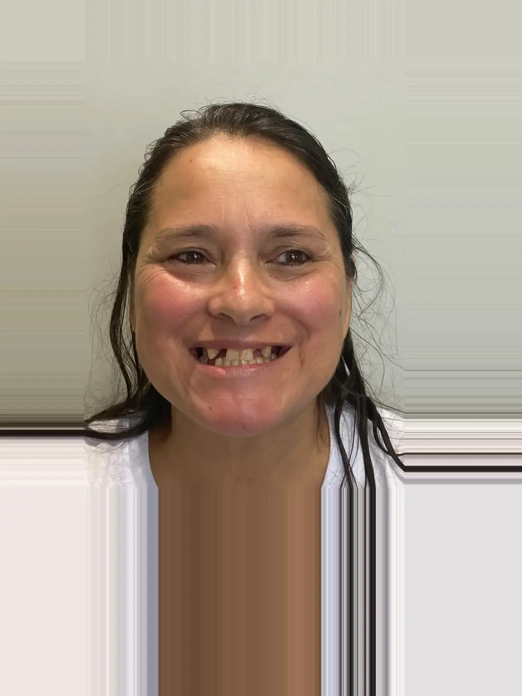 Reabilitação estética do sorriso — antes
