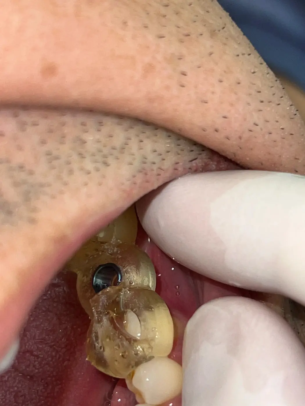 Guia cirúrgico posicionado em boca durante a cirurgia de implante