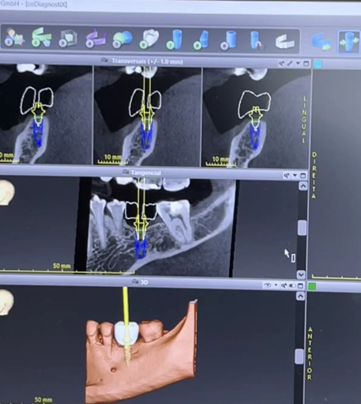Planejamento digital de implante com tomografia computadorizada